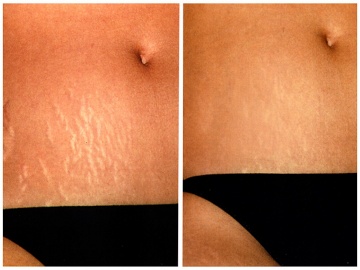 HSKIN2